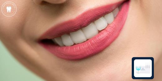 What is the ideal frequency of using a teeth whitening kit?